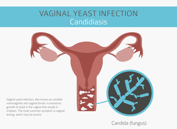 A yeast infection is fungal. See an experience gynecologist in Cool Springs and Brentwood, Tennessee
