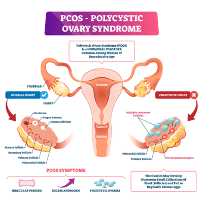 PCOS Signs Symptoms And Treatments Cool Springs OBGYN