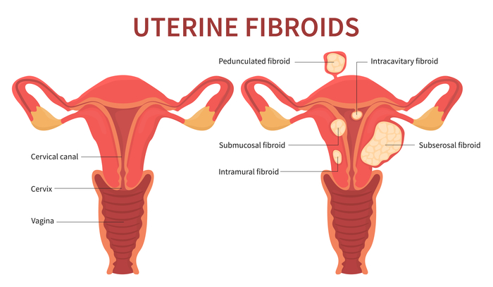 Illustration of different types of uterine fibroids. Contact Dr. Lodge for treatment in Cool Springs and Brentwood, Tennessee. 