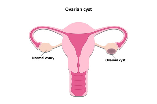 Diagram of the uterus and ovarian cyst location - See Dr. Lodge in Brentwood for treatment of ovarian cysts 