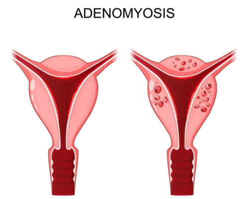 Adenomyosis: Could it be the suspect of heavy, painful periods?