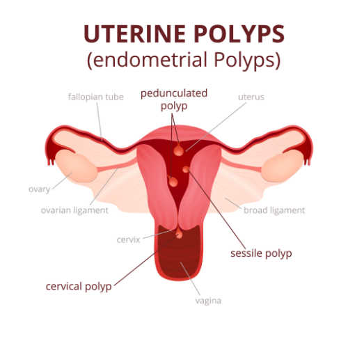 diagram showing where uterine polyps are located